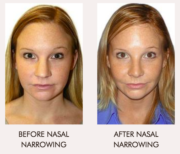 RHINOPLASTY (NOSE JOB) IN WASHINGTON DC